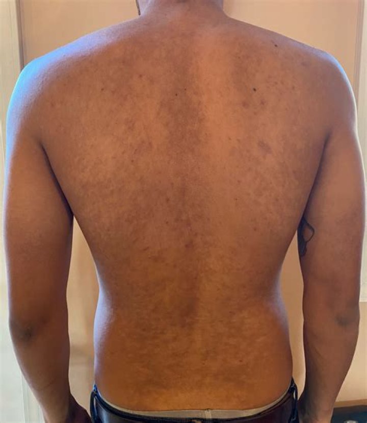 Is tinea versicolor curable?