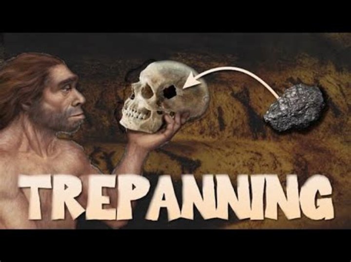 Is trepanning still used today?