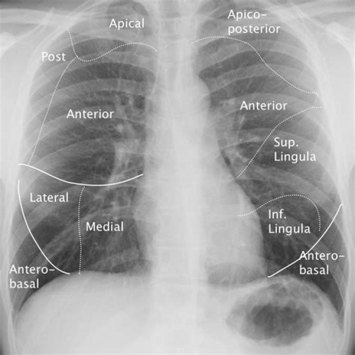 Should the lateral chest radiograph be routinely performed?