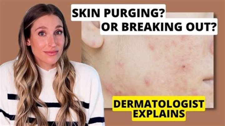 Should you pop purging pimples?