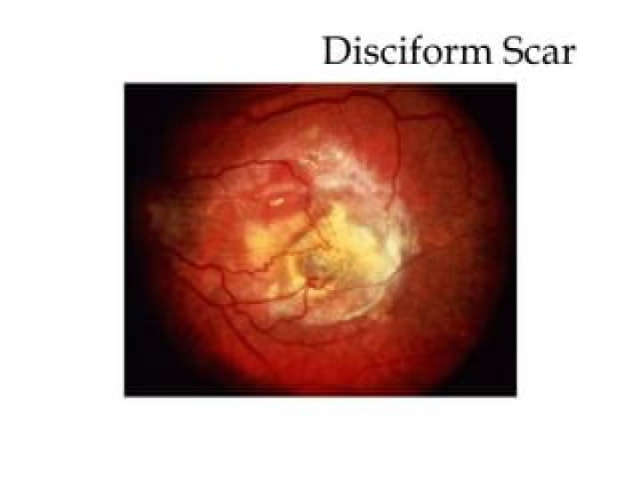 What causes disciform scar?