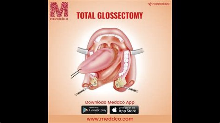 What do glossectomy mean?