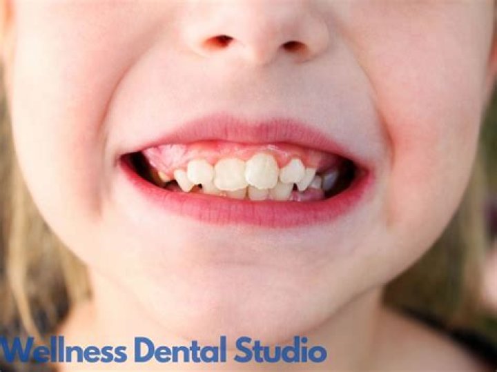 What is a buckled tooth?