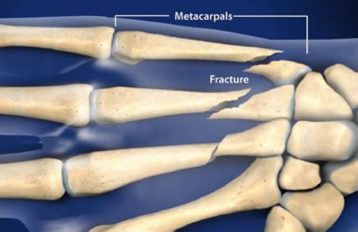 What is a metacarpal fracture?