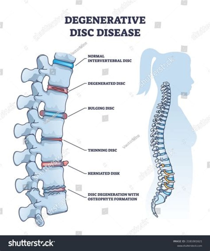 What is discovertebral disease?