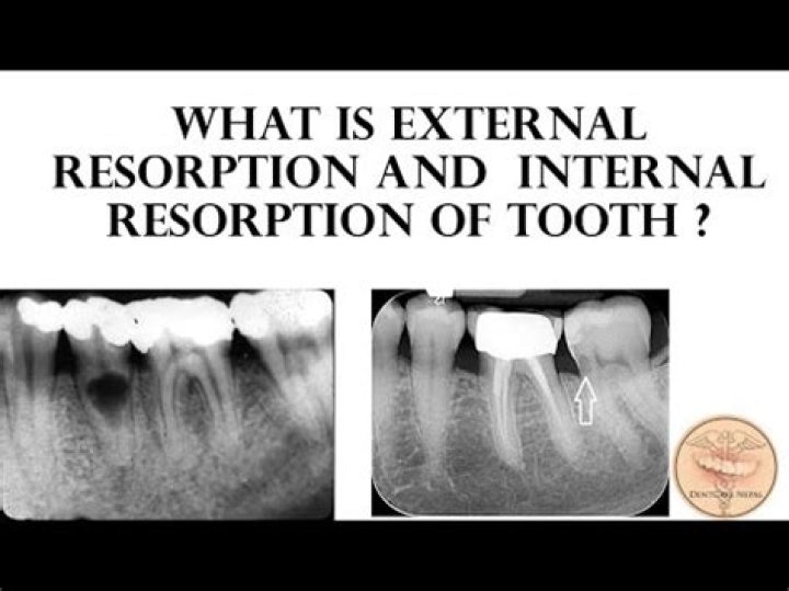 What is external resorption?