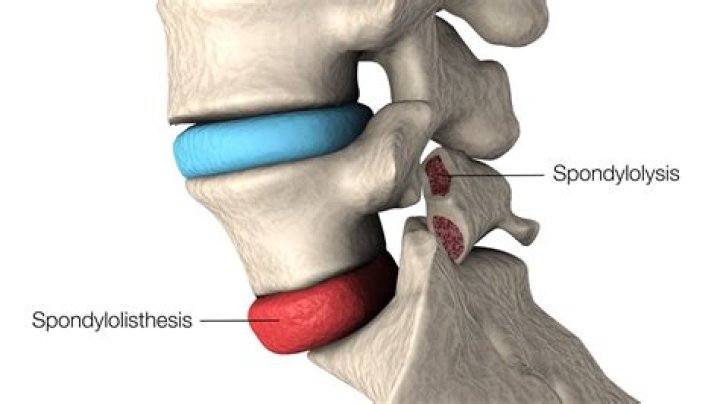 What is lumbar spondylitis?