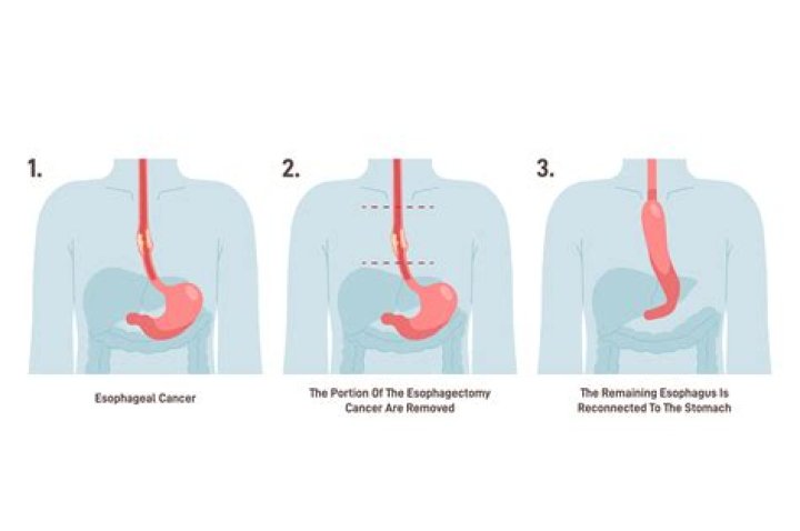 What is oesophago gastrectomy?