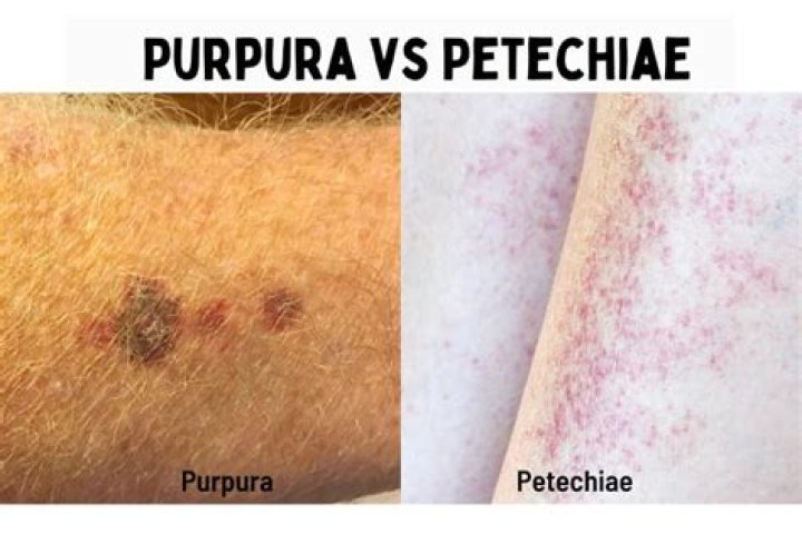 What is the difference between petechiae and ecchymosis?