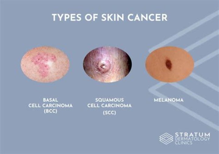What is the most common type of skin cancer?