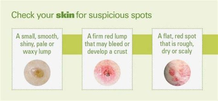 What is the most serious type of skin cancer quizlet?