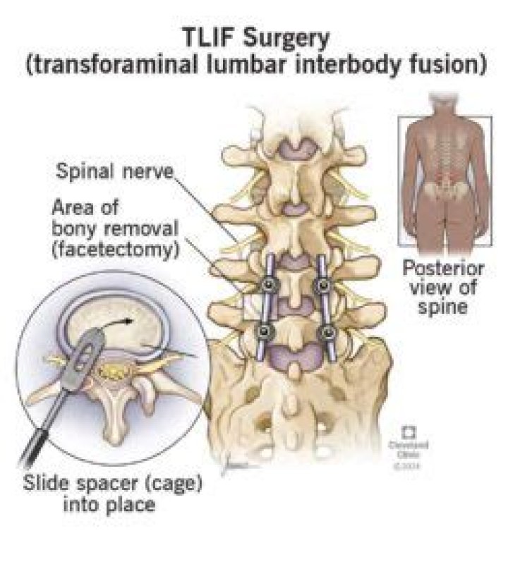 What is transforaminal lumbar interbody fusion?