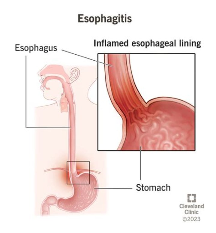What is ulcerative oesophagitis?