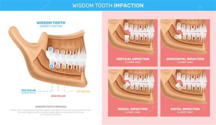 What to do when wisdom teeth come in?