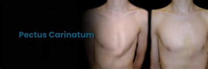 Whats a pectus carinatum?