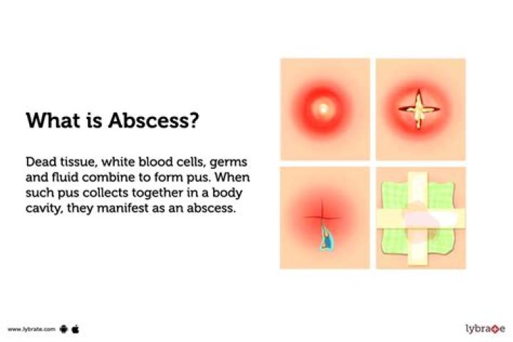 When do abscesses go away?