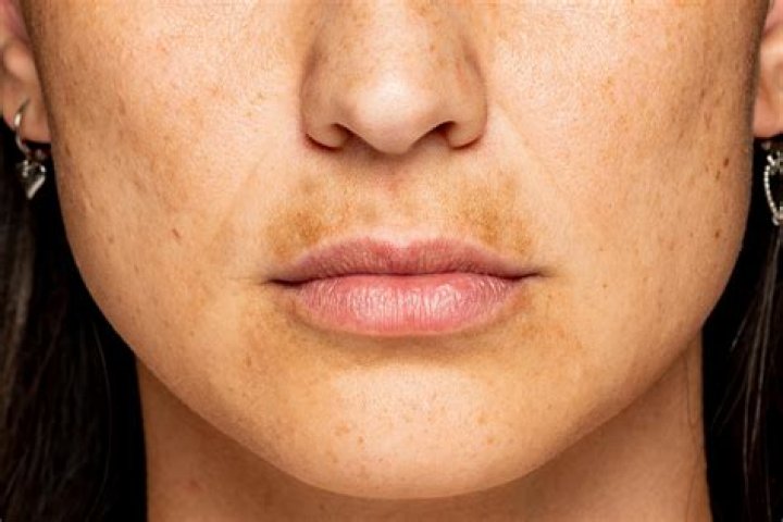 When does pigmentation go after pregnancy?