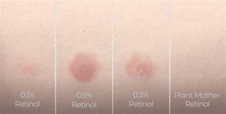 When does skin purging start?