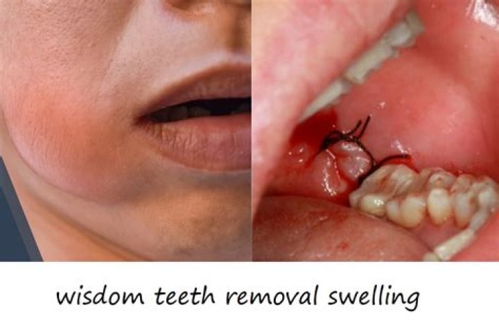 When wisdom teeth stop growing?