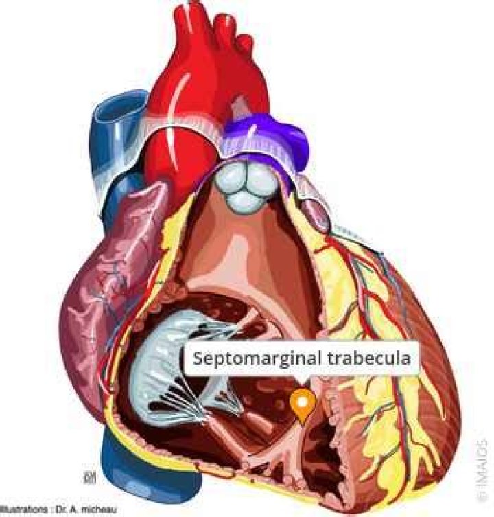 Where do you find septomarginal trabecula?