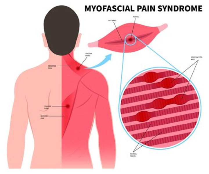 Where is myalgia pain?