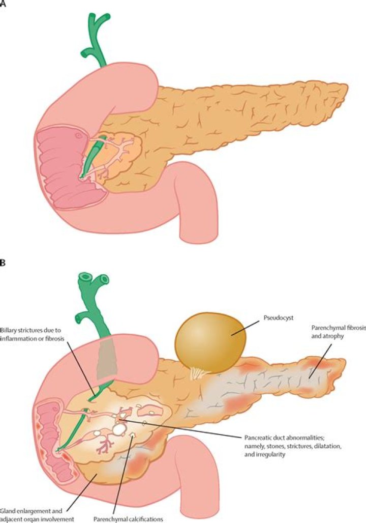Where is pancreatic pseudocyst?