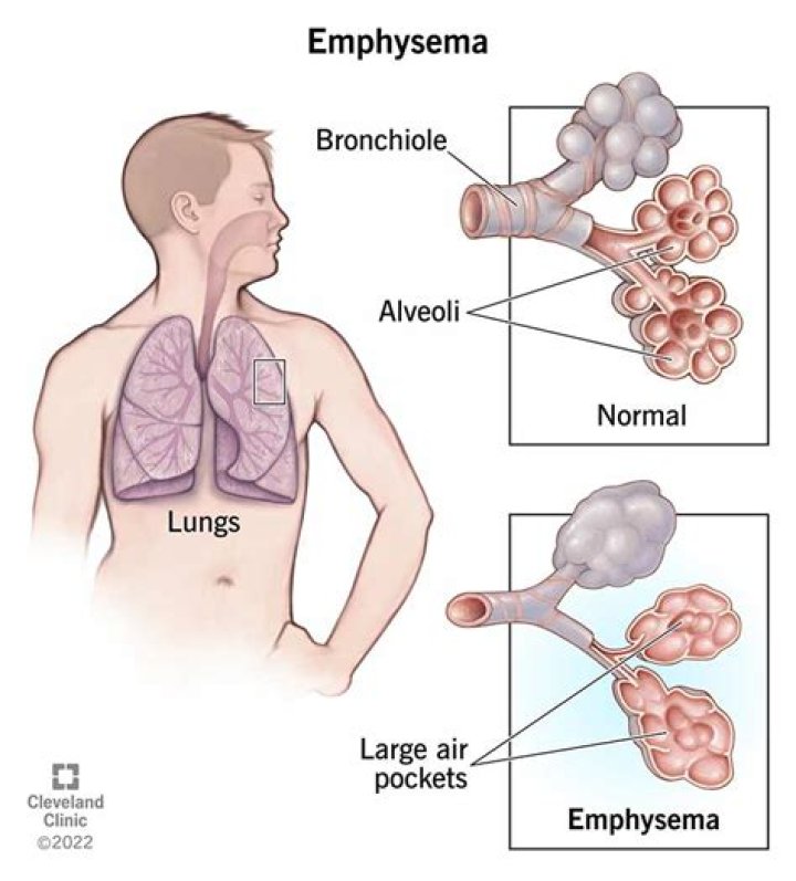 Which statements are characteristic of emphysema?