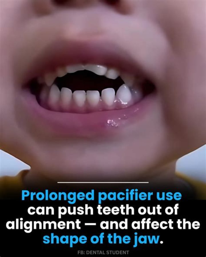 Why do teeth flare out?