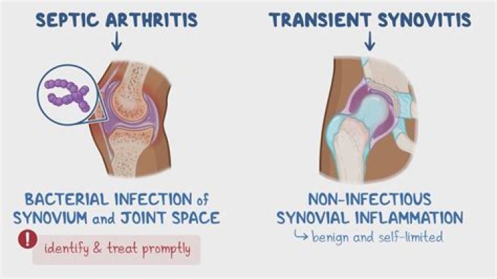Why is synovitis painful?