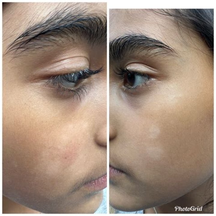 Why is tinea versicolor itchy?