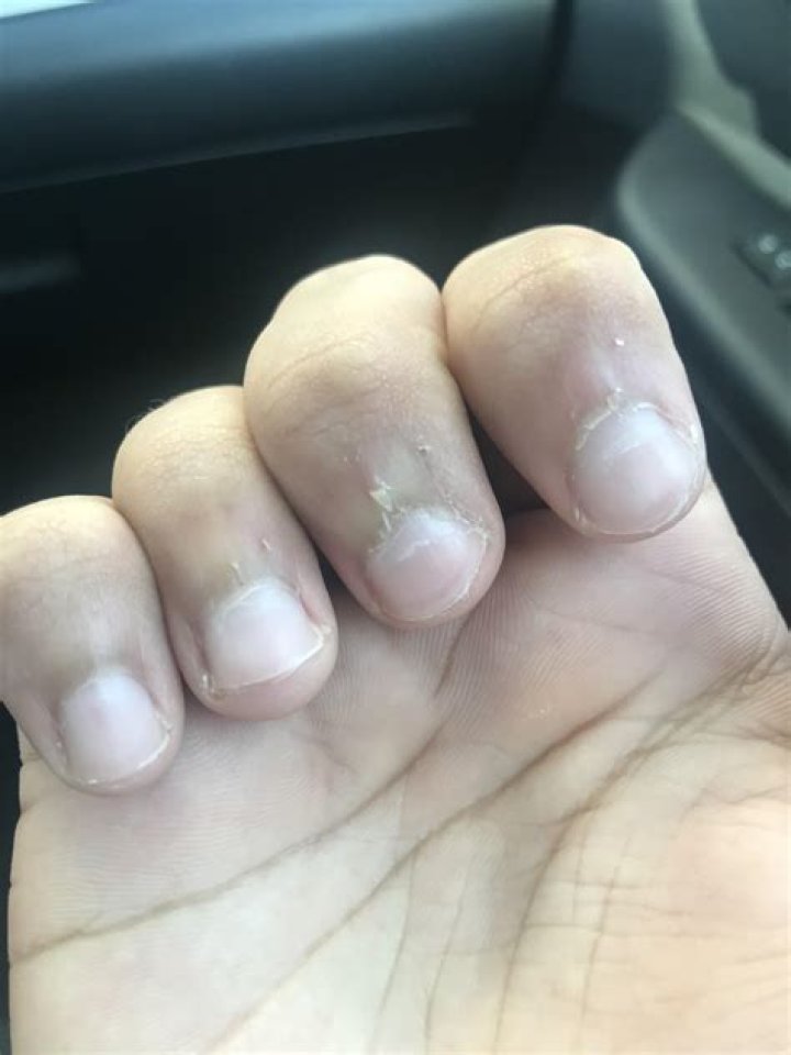 Why skin around nails peeling?