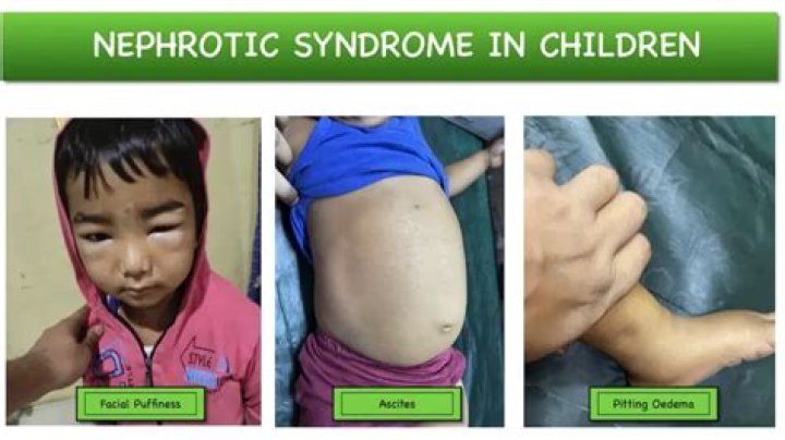 Will nephrotic syndrome come back?