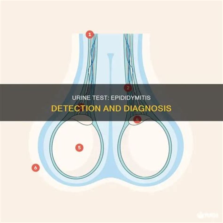 Would epididymitis show up in a urine test?
